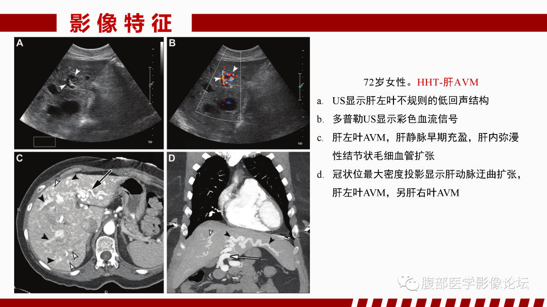 影像PPT - 【PPT】肝脏血管性病变影像学表现-78