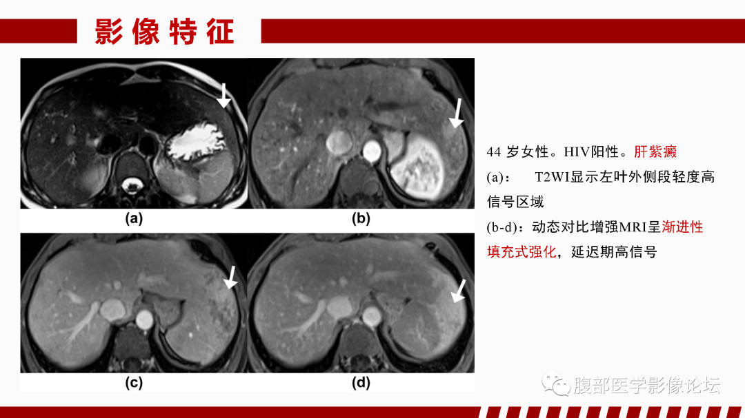影像PPT - 【PPT】肝脏血管性病变影像学表现-84