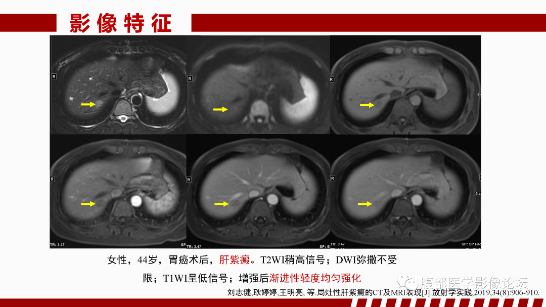 影像PPT - 【PPT】肝脏血管性病变影像学表现-86