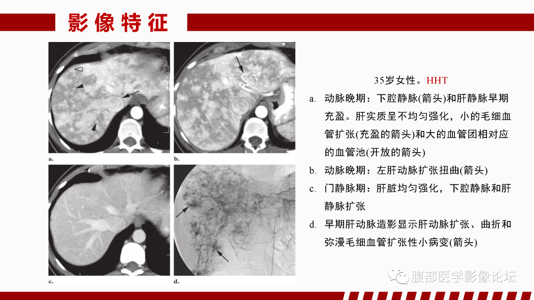 影像PPT - 【PPT】肝脏血管性病变影像学表现-79