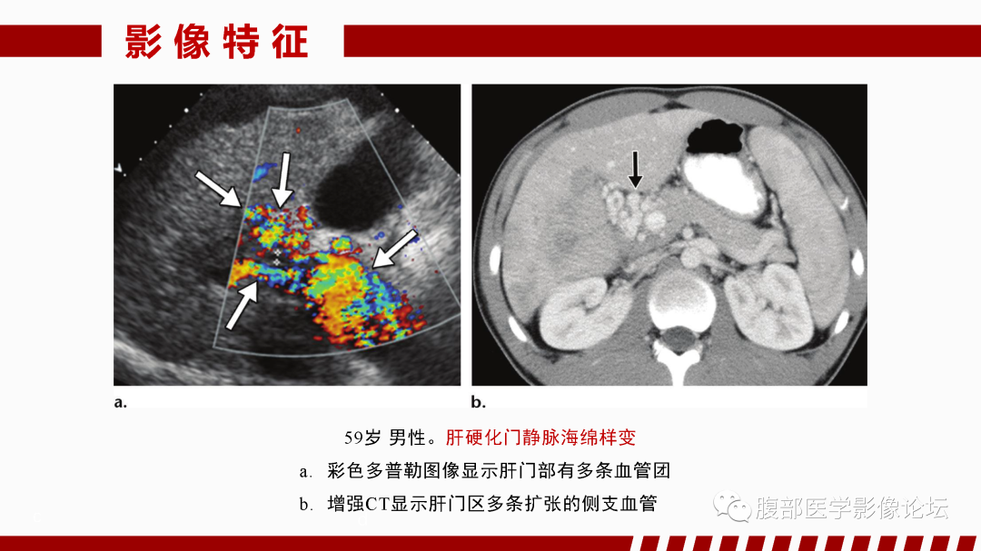 影像PPT - 【PPT】肝脏血管性病变影像学表现-45