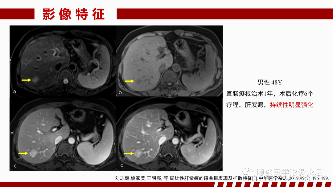影像PPT - 【PPT】肝脏血管性病变影像学表现-87