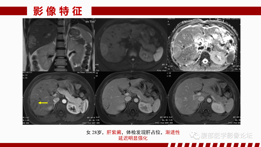 影像PPT - 【PPT】肝脏血管性病变影像学表现-88