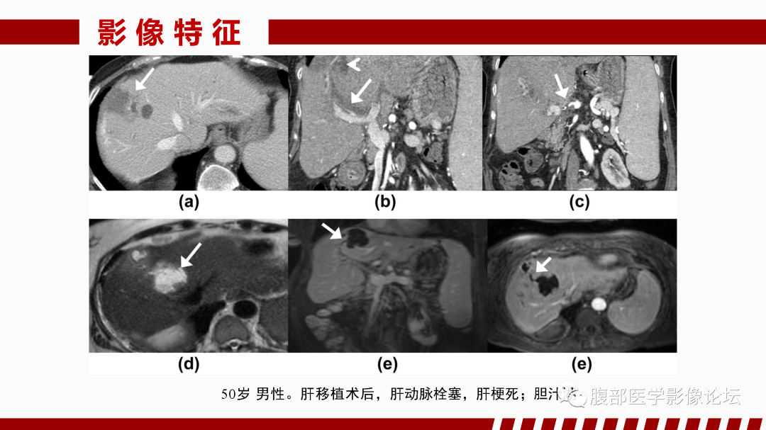 影像PPT - 【PPT】肝脏血管性病变影像学表现-57