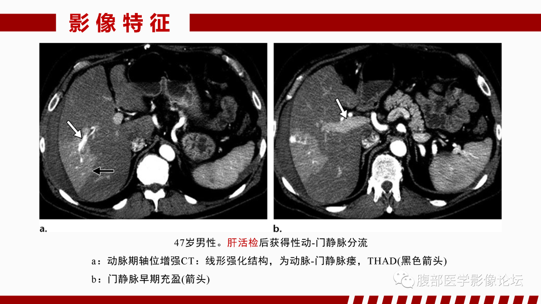 影像PPT - 【PPT】肝脏血管性病变影像学表现-65
