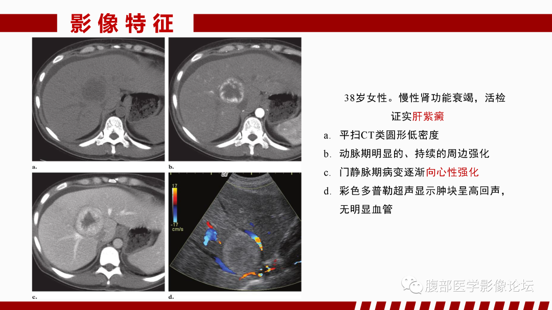 影像PPT - 【PPT】肝脏血管性病变影像学表现-85