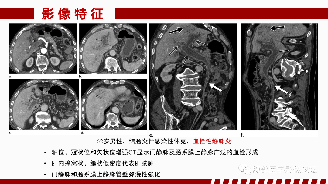 影像PPT - 【PPT】肝脏血管性病变影像学表现-1