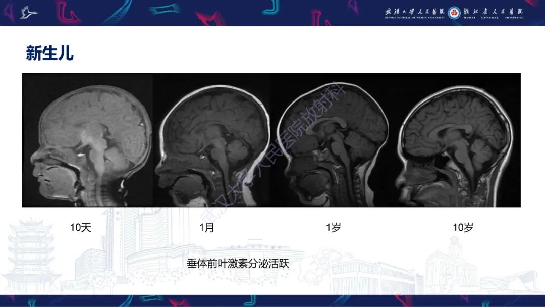 影像PPT - 【PPT】鞍区T1WI高信号病变影像诊断-8
