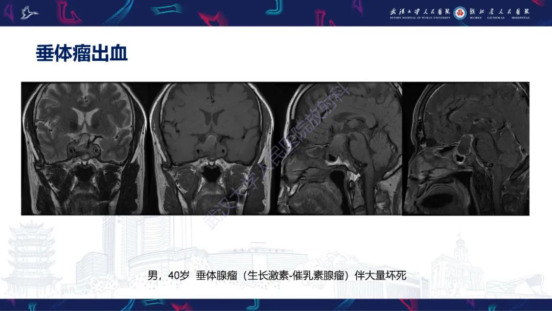 影像PPT - 【PPT】鞍区T1WI高信号病变影像诊断-13
