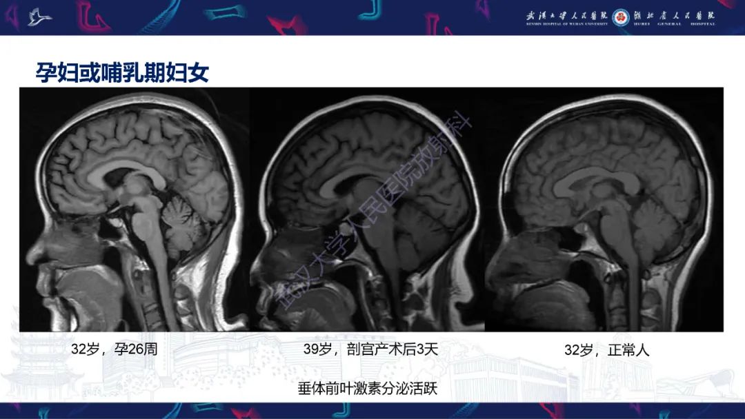 影像PPT - 【PPT】鞍区T1WI高信号病变影像诊断-9