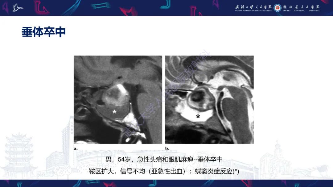 影像PPT - 【PPT】鞍区T1WI高信号病变影像诊断-16