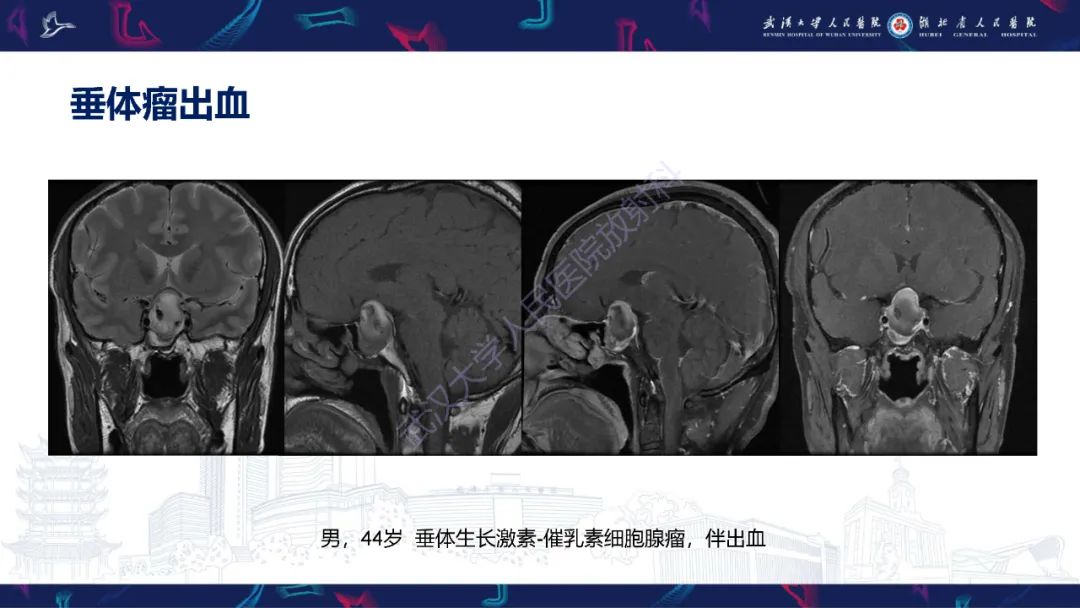 影像PPT - 【PPT】鞍区T1WI高信号病变影像诊断-12