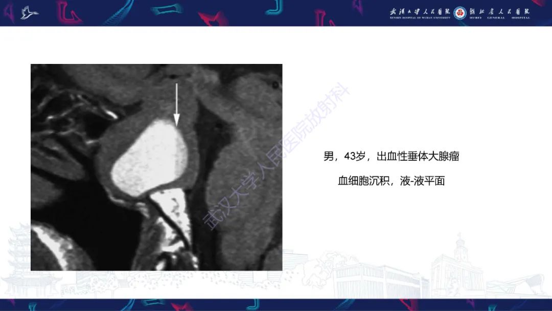影像PPT - 【PPT】鞍区T1WI高信号病变影像诊断-14