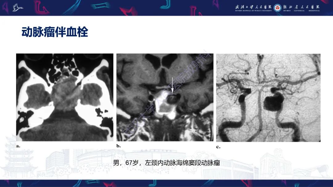 影像PPT - 【PPT】鞍区T1WI高信号病变影像诊断-19