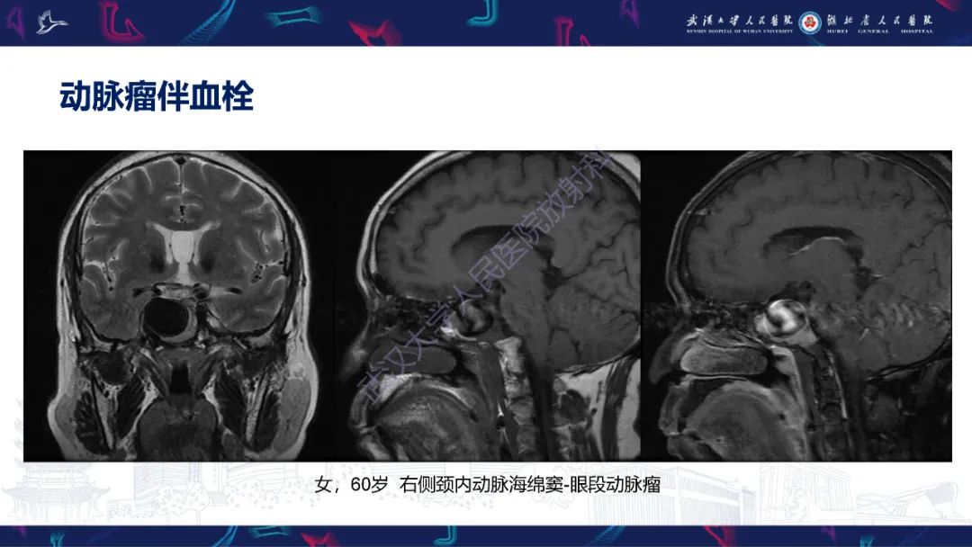 影像PPT - 【PPT】鞍区T1WI高信号病变影像诊断-21