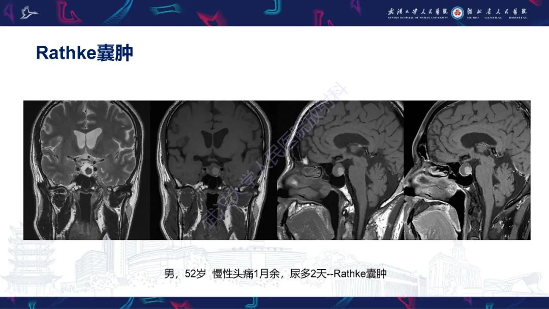 影像PPT - 【PPT】鞍区T1WI高信号病变影像诊断-23