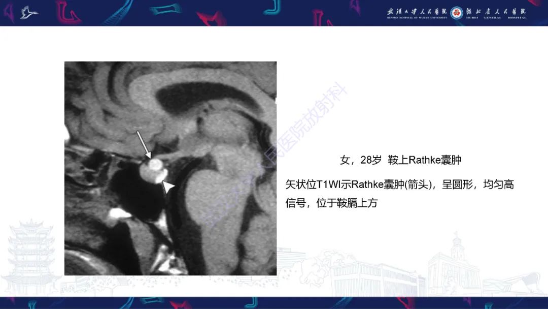 影像PPT - 【PPT】鞍区T1WI高信号病变影像诊断-26