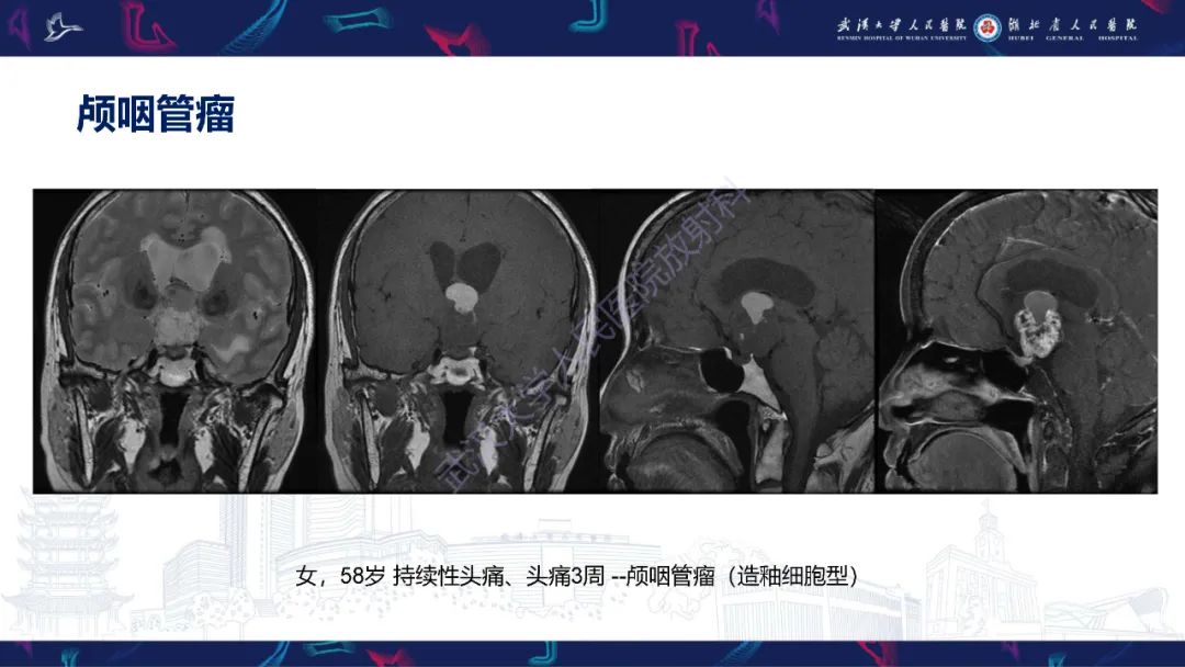 影像PPT - 【PPT】鞍区T1WI高信号病变影像诊断-29