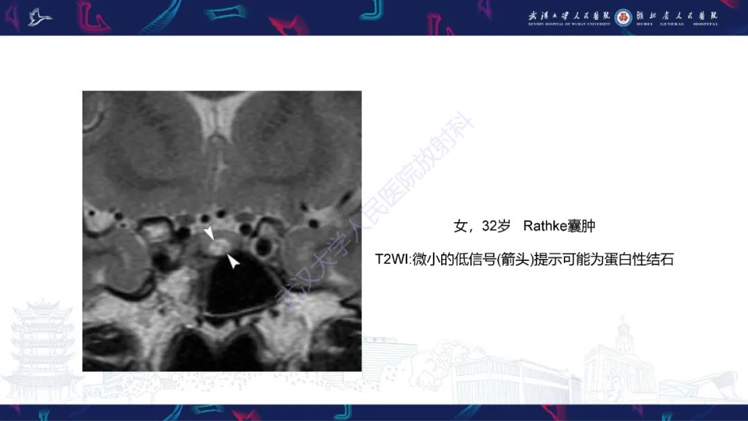 影像PPT - 【PPT】鞍区T1WI高信号病变影像诊断-25