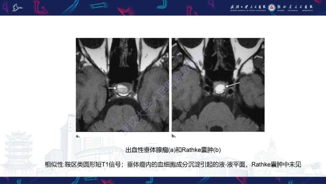 影像PPT - 【PPT】鞍区T1WI高信号病变影像诊断-27