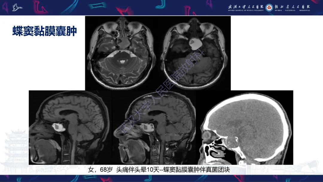 影像PPT - 【PPT】鞍区T1WI高信号病变影像诊断-32