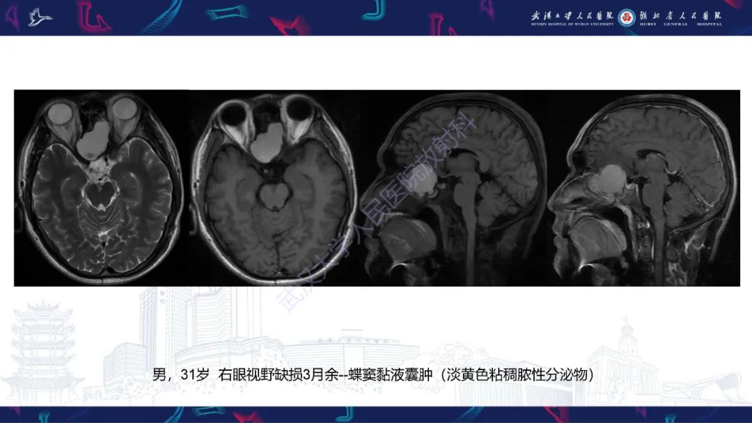 影像PPT - 【PPT】鞍区T1WI高信号病变影像诊断-33