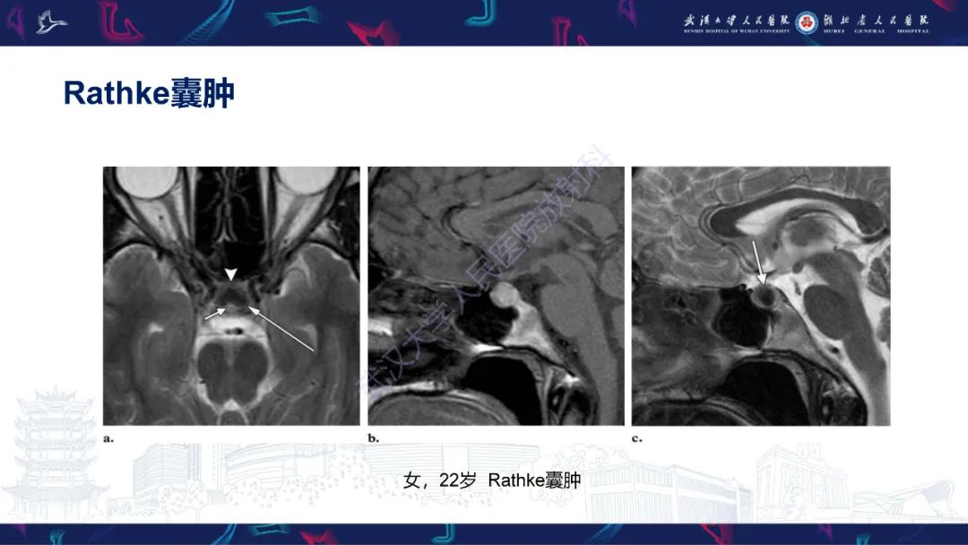 影像PPT - 【PPT】鞍区T1WI高信号病变影像诊断-24