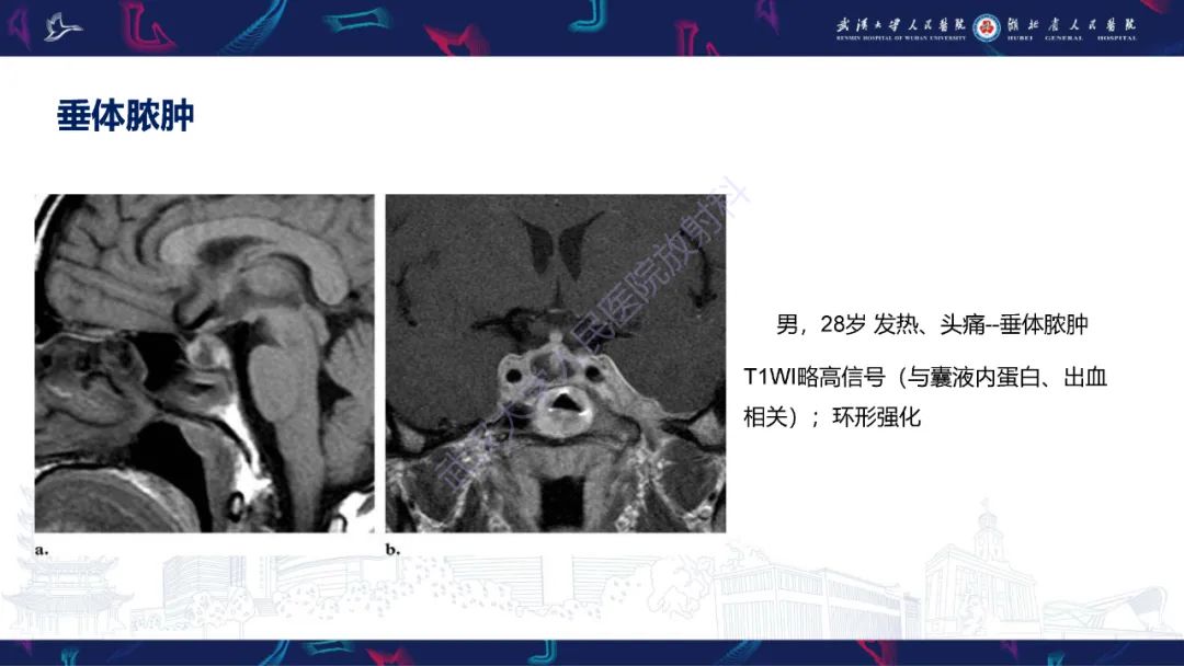 影像PPT - 【PPT】鞍区T1WI高信号病变影像诊断-34