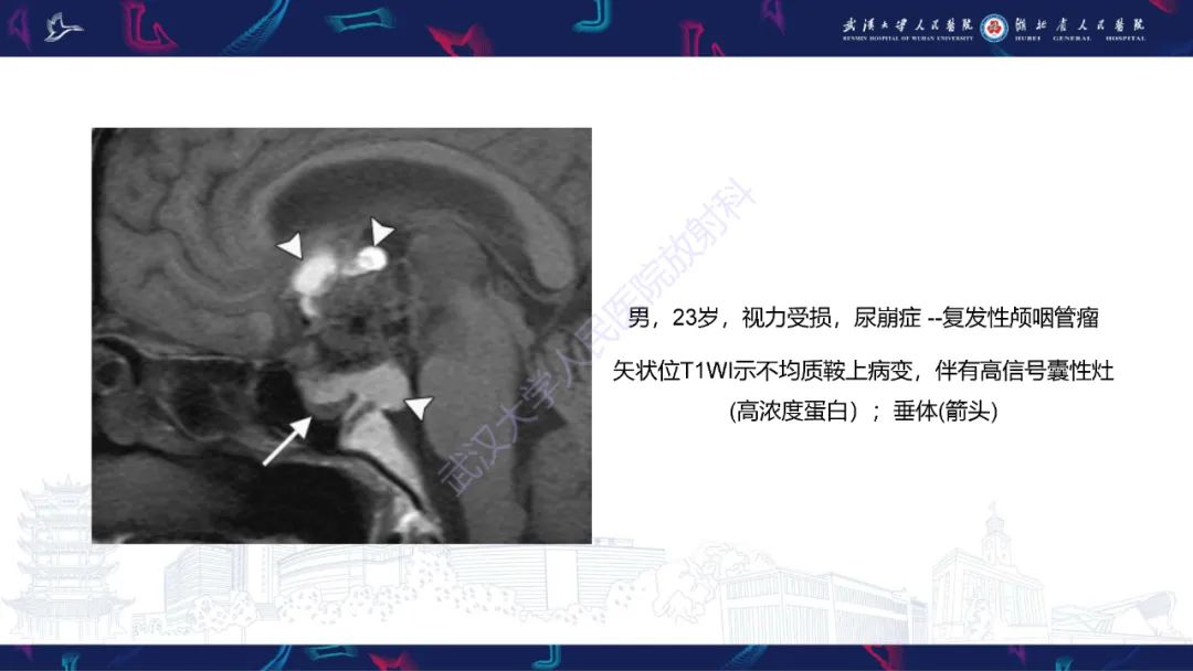 影像PPT - 【PPT】鞍区T1WI高信号病变影像诊断-30
