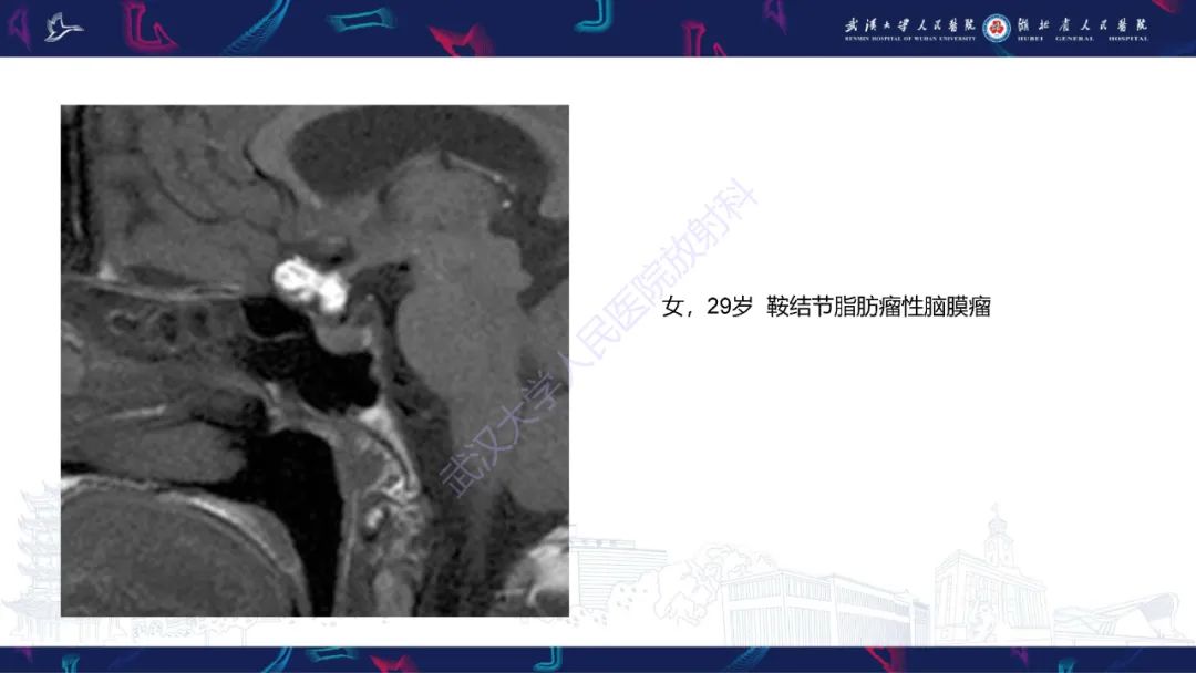 影像PPT - 【PPT】鞍区T1WI高信号病变影像诊断-38