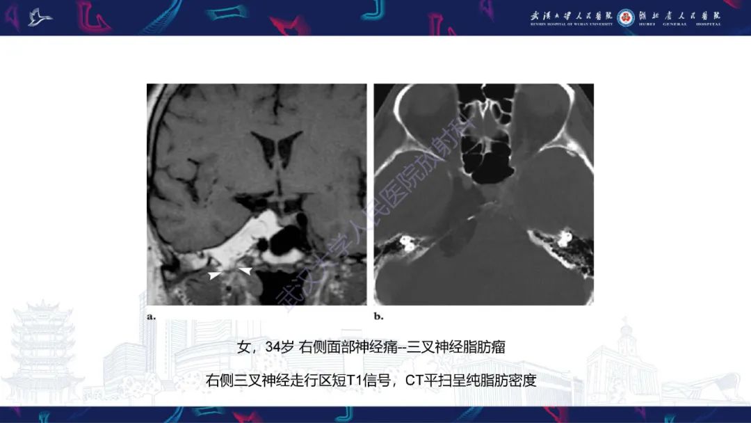 影像PPT - 【PPT】鞍区T1WI高信号病变影像诊断-35