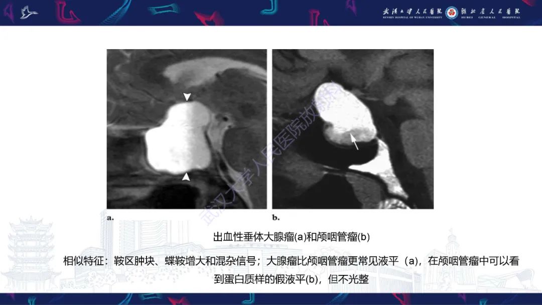 影像PPT - 【PPT】鞍区T1WI高信号病变影像诊断-31