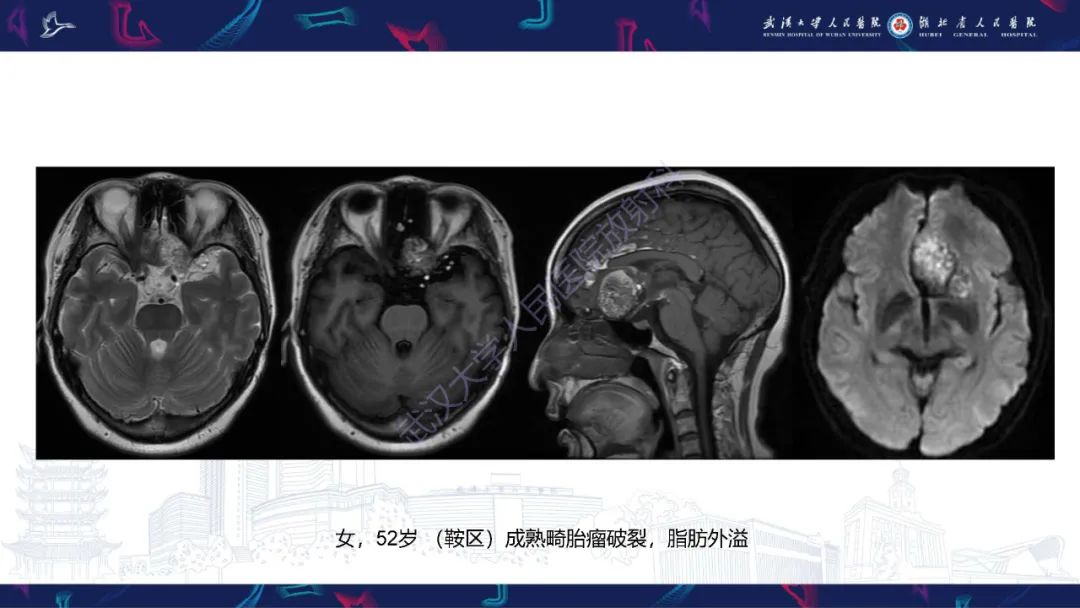 影像PPT - 【PPT】鞍区T1WI高信号病变影像诊断-37