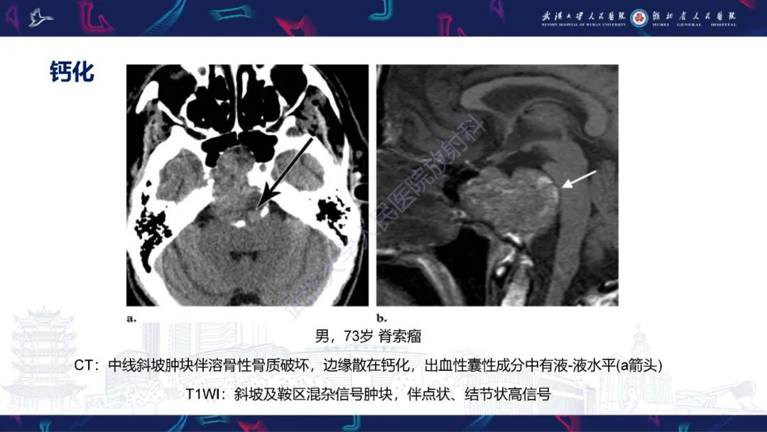 影像PPT - 【PPT】鞍区T1WI高信号病变影像诊断-45