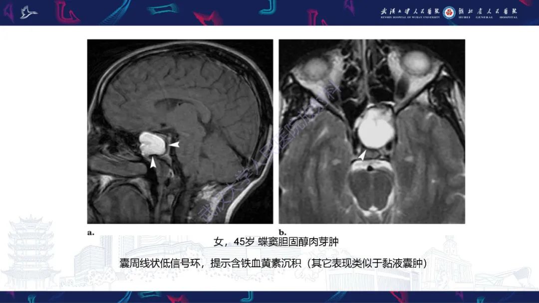 影像PPT - 【PPT】鞍区T1WI高信号病变影像诊断-40