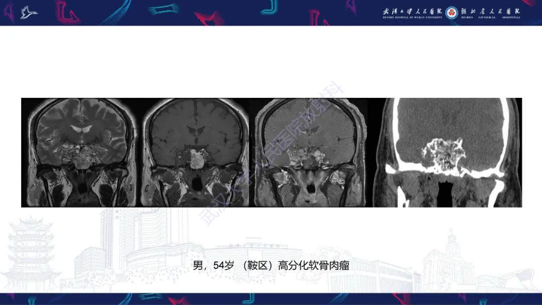 影像PPT - 【PPT】鞍区T1WI高信号病变影像诊断-48