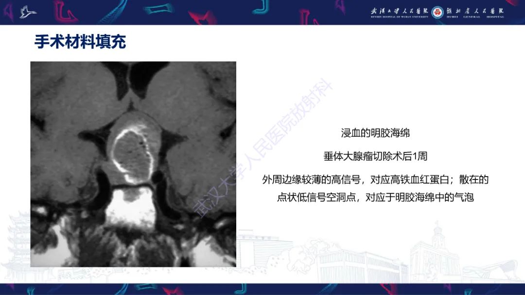 影像PPT - 【PPT】鞍区T1WI高信号病变影像诊断-50
