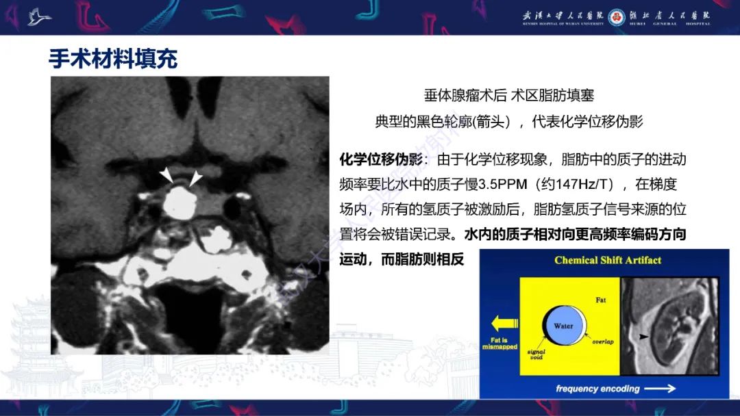 影像PPT - 【PPT】鞍区T1WI高信号病变影像诊断-51