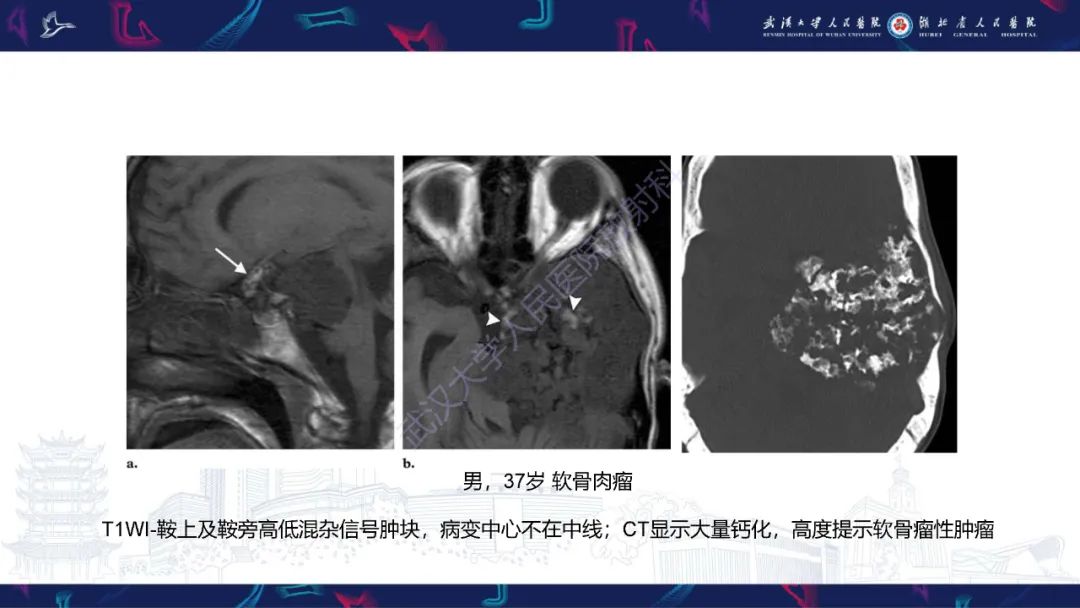 影像PPT - 【PPT】鞍区T1WI高信号病变影像诊断-47