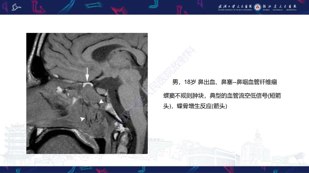 影像PPT - 【PPT】鞍区T1WI高信号病变影像诊断-44