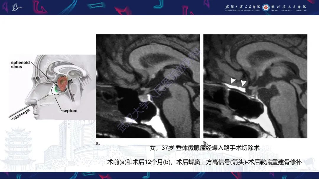 影像PPT - 【PPT】鞍区T1WI高信号病变影像诊断-53