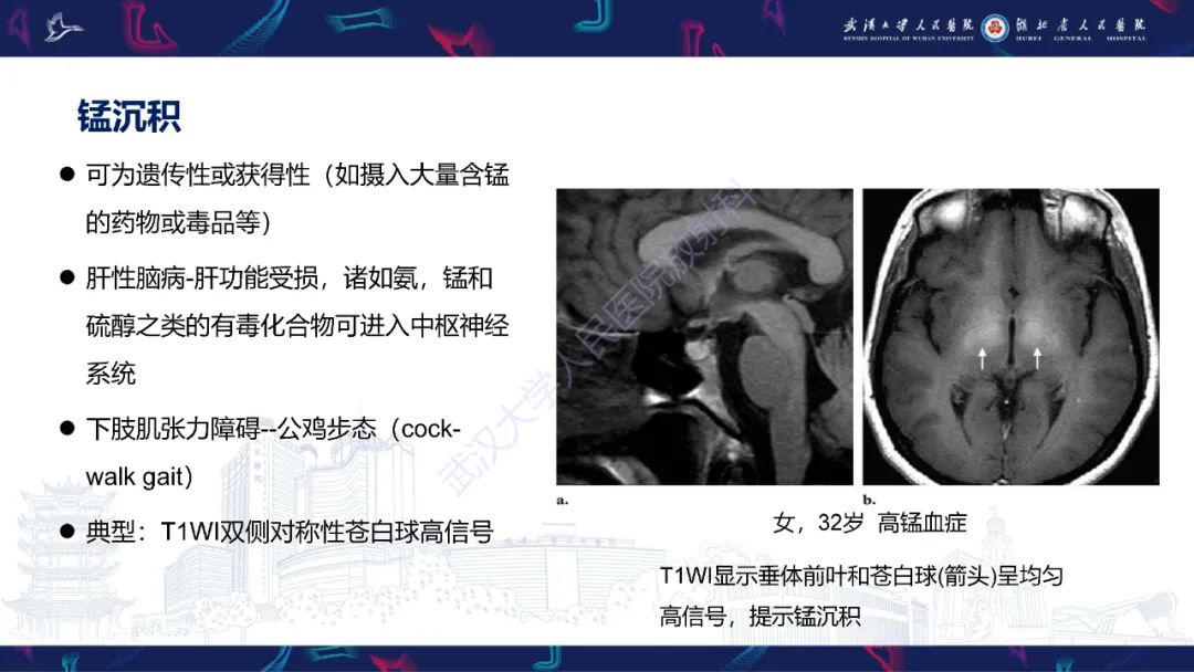 影像PPT - 【PPT】鞍区T1WI高信号病变影像诊断-49