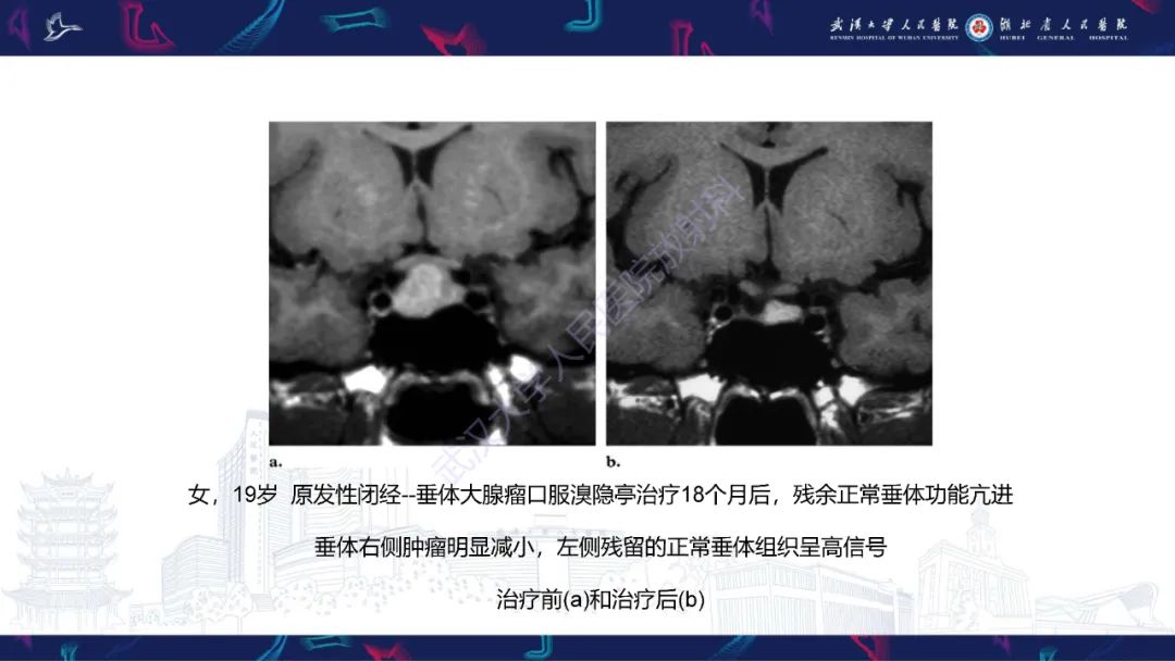 影像PPT - 【PPT】鞍区T1WI高信号病变影像诊断-54