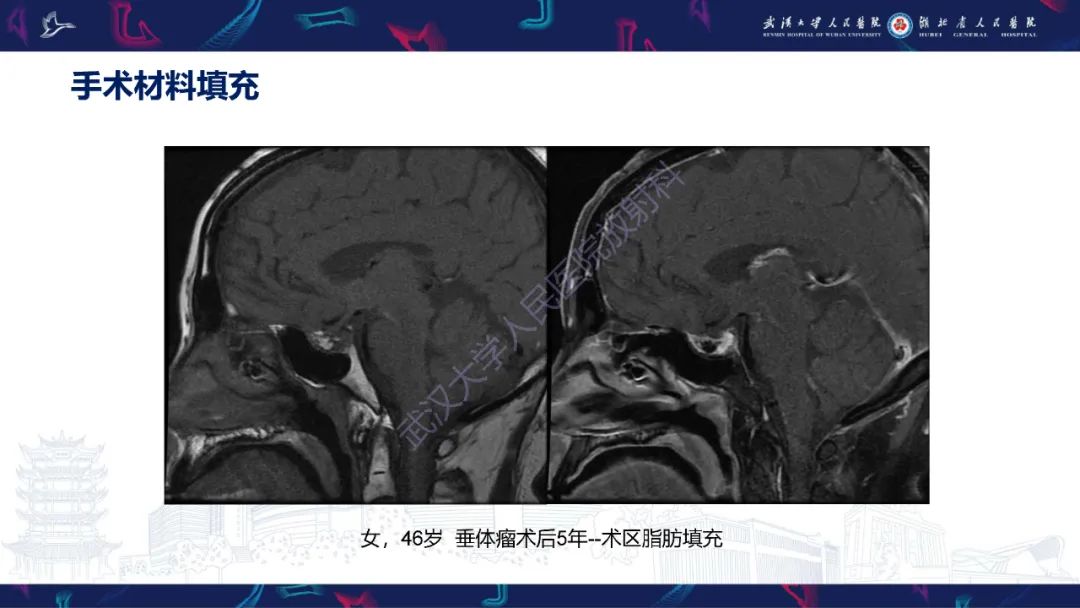 影像PPT - 【PPT】鞍区T1WI高信号病变影像诊断-52
