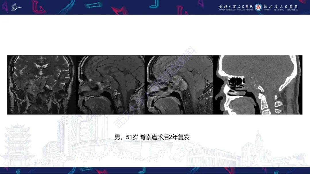 影像PPT - 【PPT】鞍区T1WI高信号病变影像诊断-46
