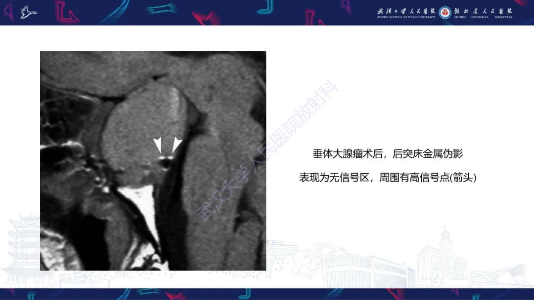 影像PPT - 【PPT】鞍区T1WI高信号病变影像诊断-56