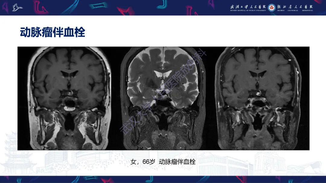 影像PPT - 【PPT】鞍区T1WI高信号病变影像诊断-2