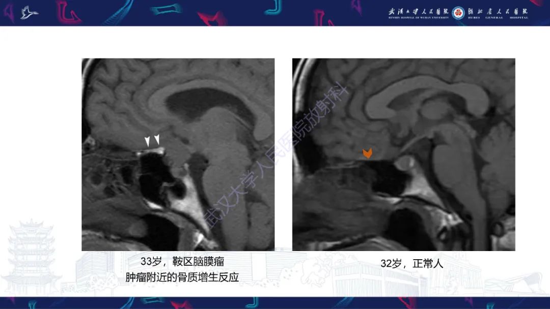 影像PPT - 【PPT】鞍区T1WI高信号病变影像诊断-3