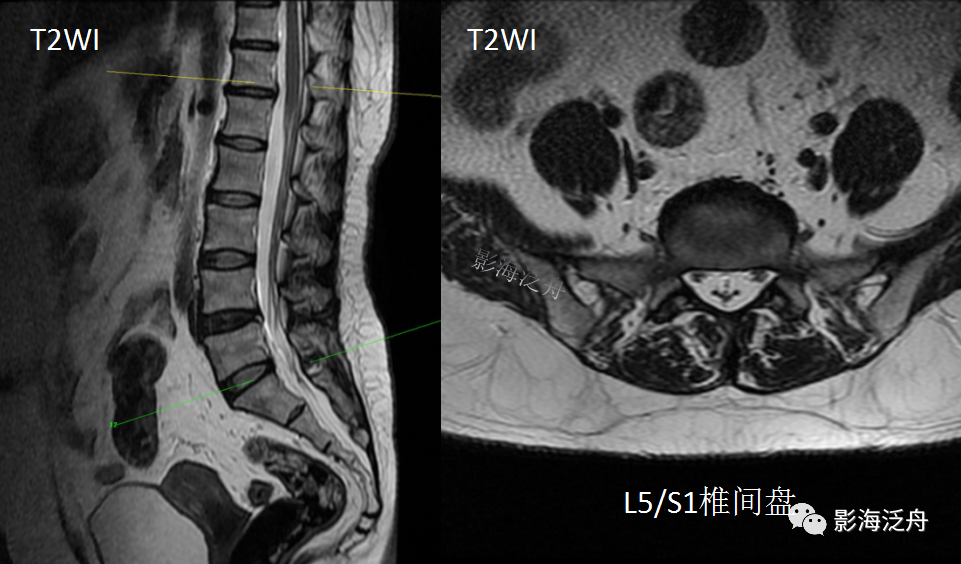 影像PPT - 椎管内硬膜外脂肪增多症-5 影像PPT - 椎管内硬膜外脂肪增多症-5
