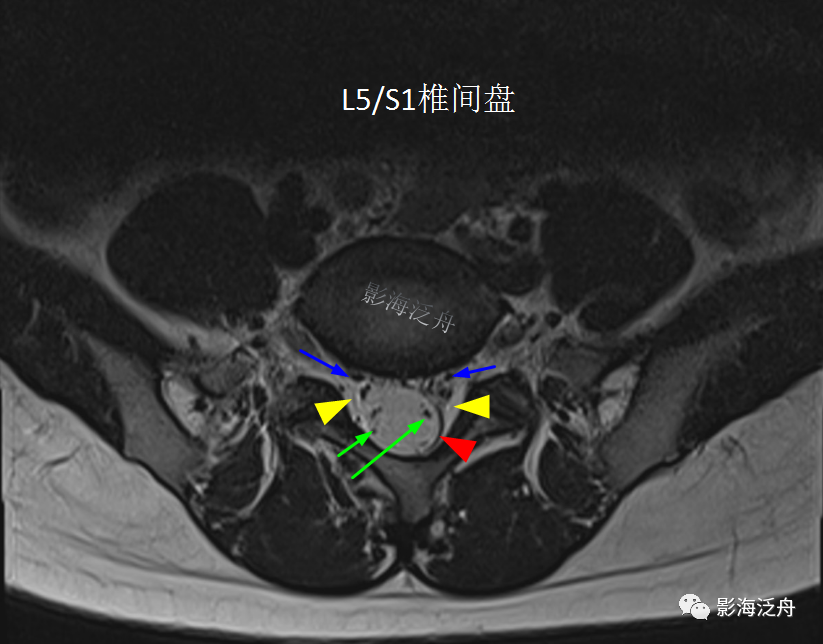 影像PPT - 椎管内硬膜外脂肪增多症-11 影像PPT - 椎管内硬膜外脂肪增多症-11